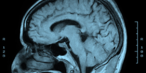 An image made using MRI of a human head